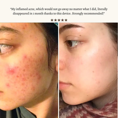 Primalderm High Frequency Therapy | Clear Acne and Prevent Future Breakouts