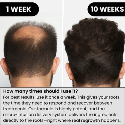 AlphaInfuse™ Hair Regrowth System