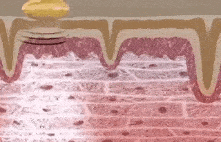 Primalderm High Frequency Therapy | Clear Acne and Prevent Future Breakouts