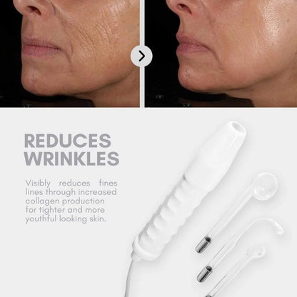 Primalderm High Frequency Therapy | Clear Acne and Prevent Future Breakouts